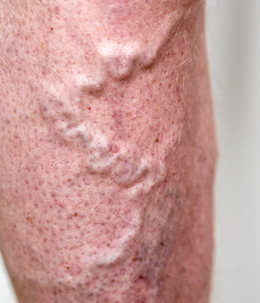 Varicose veins