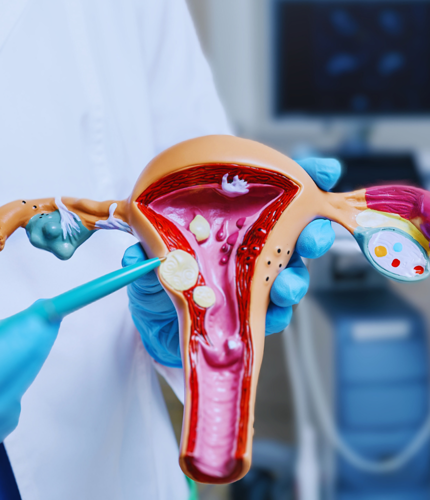 Uterine fibroids