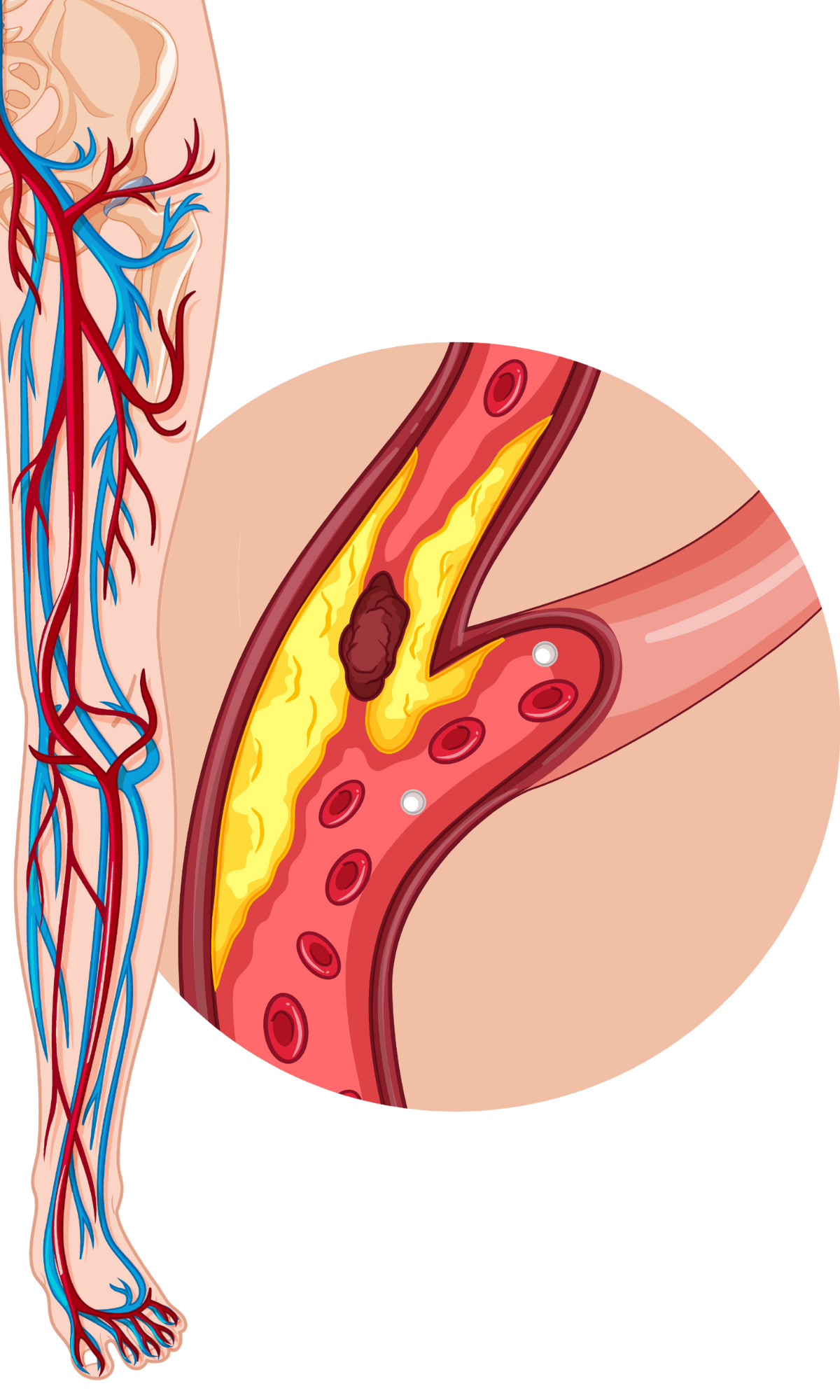 Genicular Artery Embolization